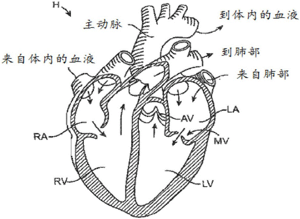 人造心瓣装置,人造二尖瓣以及相关系统和方法与流程