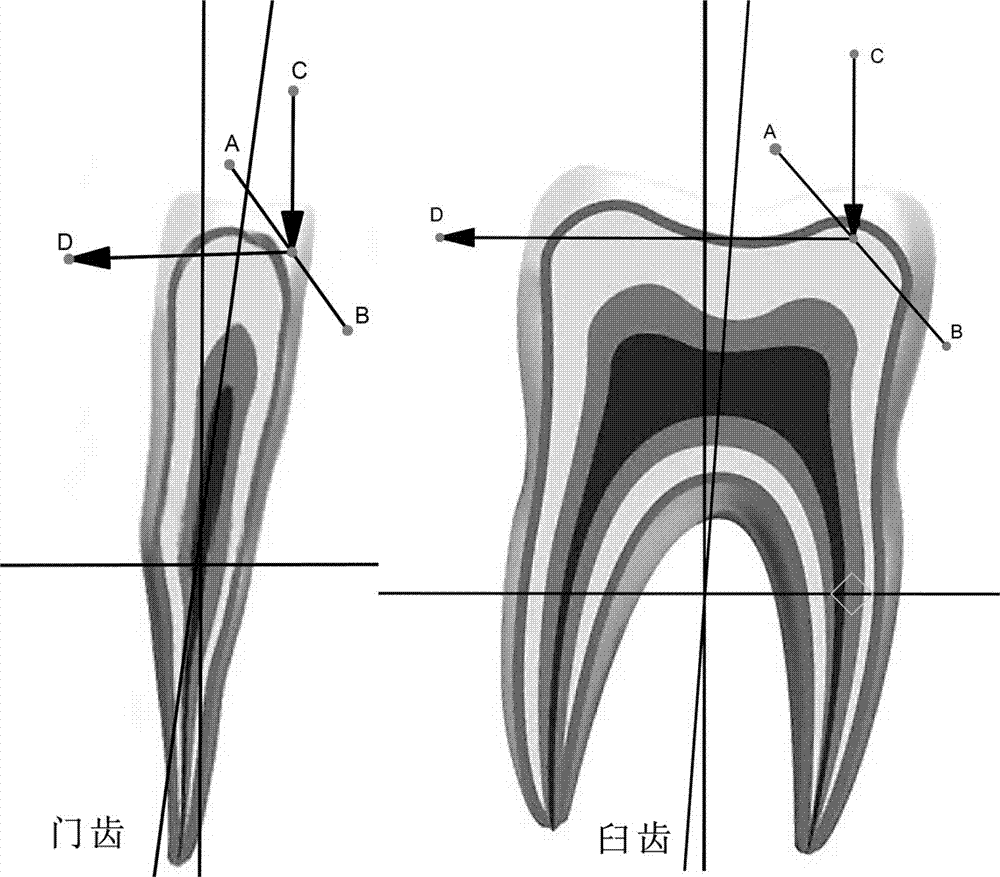 一种牙齿微矫正方法与流程