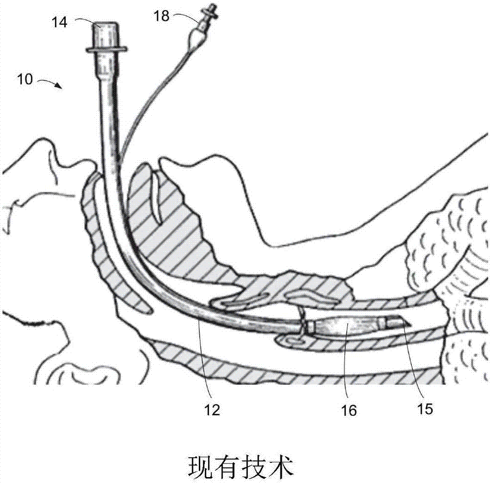 智能ETT通气附件及使用方法与流程