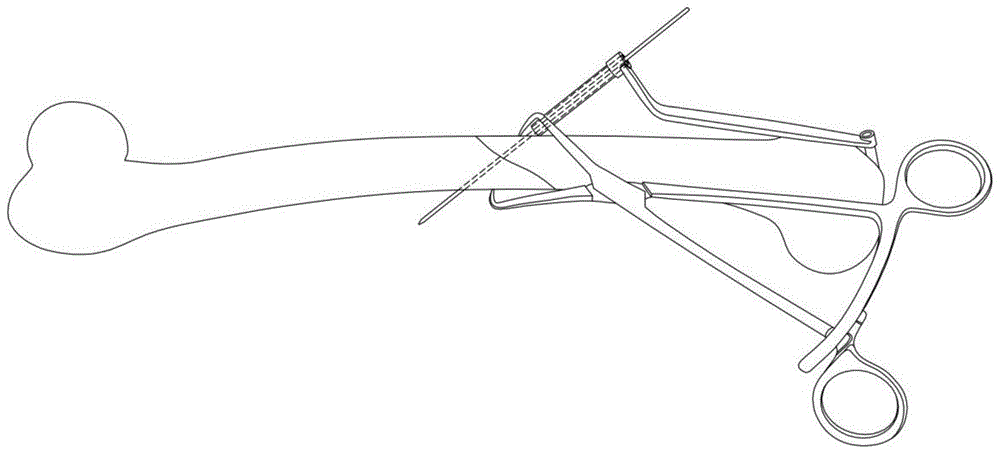 一种骨科导向复位钳的制作方法