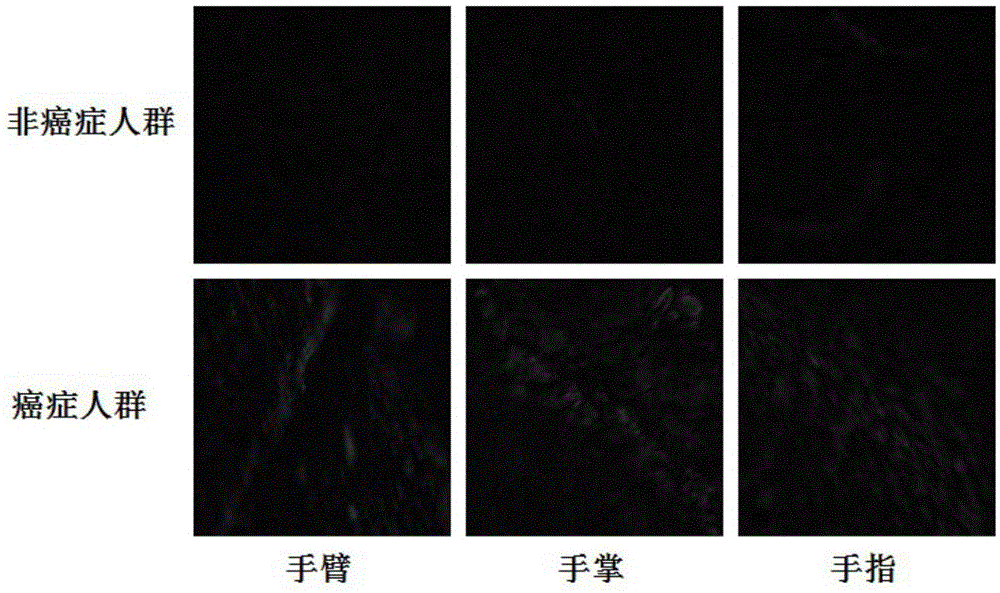 基于皮肤角蛋白片段以及角蛋白的含量检测癌症的发生和严重程度的方法及其应用与流程