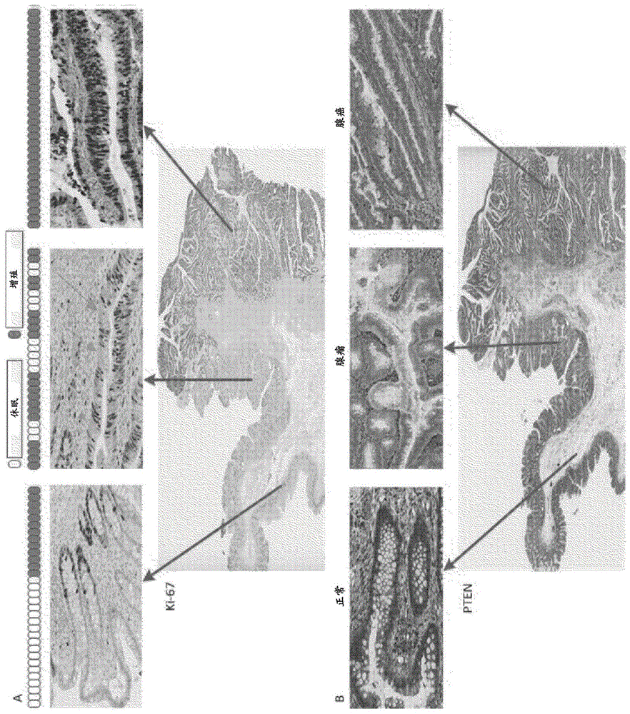 用于在癌症中检测腺瘤-腺癌过渡的方法和组合物与流程
