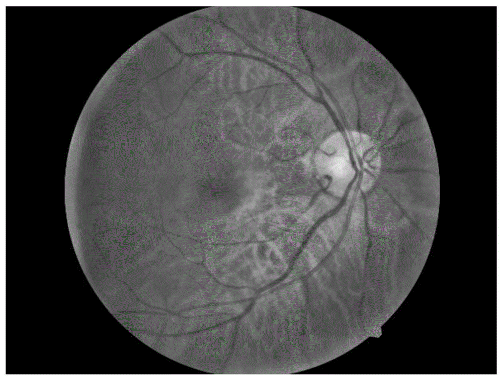 一种视网膜眼底彩色照片图像筛选方法与流程
