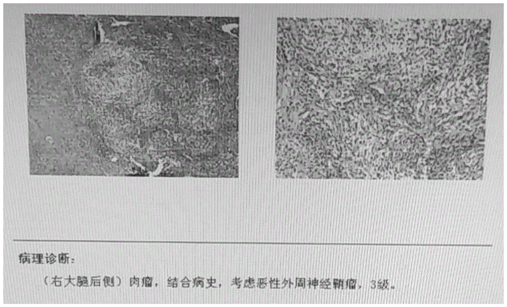 一种恶性神经鞘瘤异种移植小鼠模型的构建方法及其应用与流程