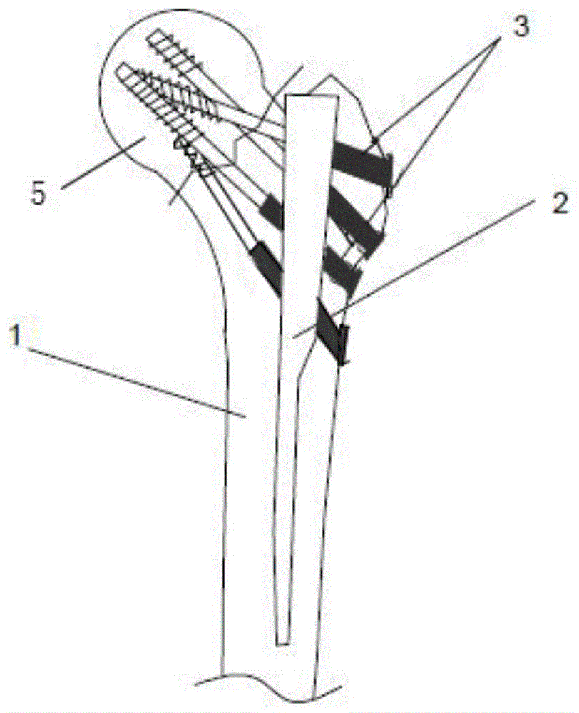 一种股骨髓内分散式抗旋转固定装置的制作方法
