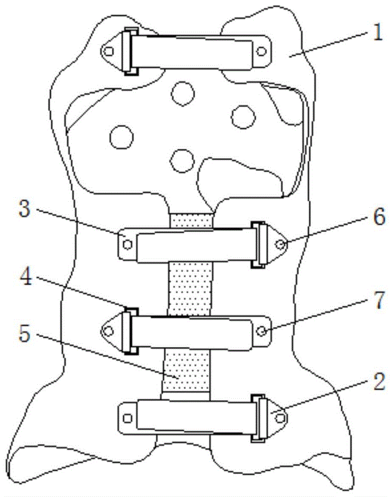 一种脊柱外科用的侧凸矫形支具的制作方法