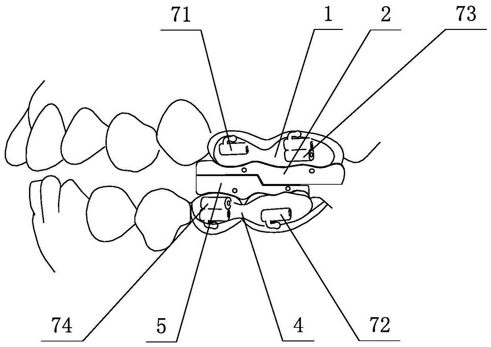 医疗器械制造及应用技术所述上颌矫治器包括安装在上颌左,右两侧第一