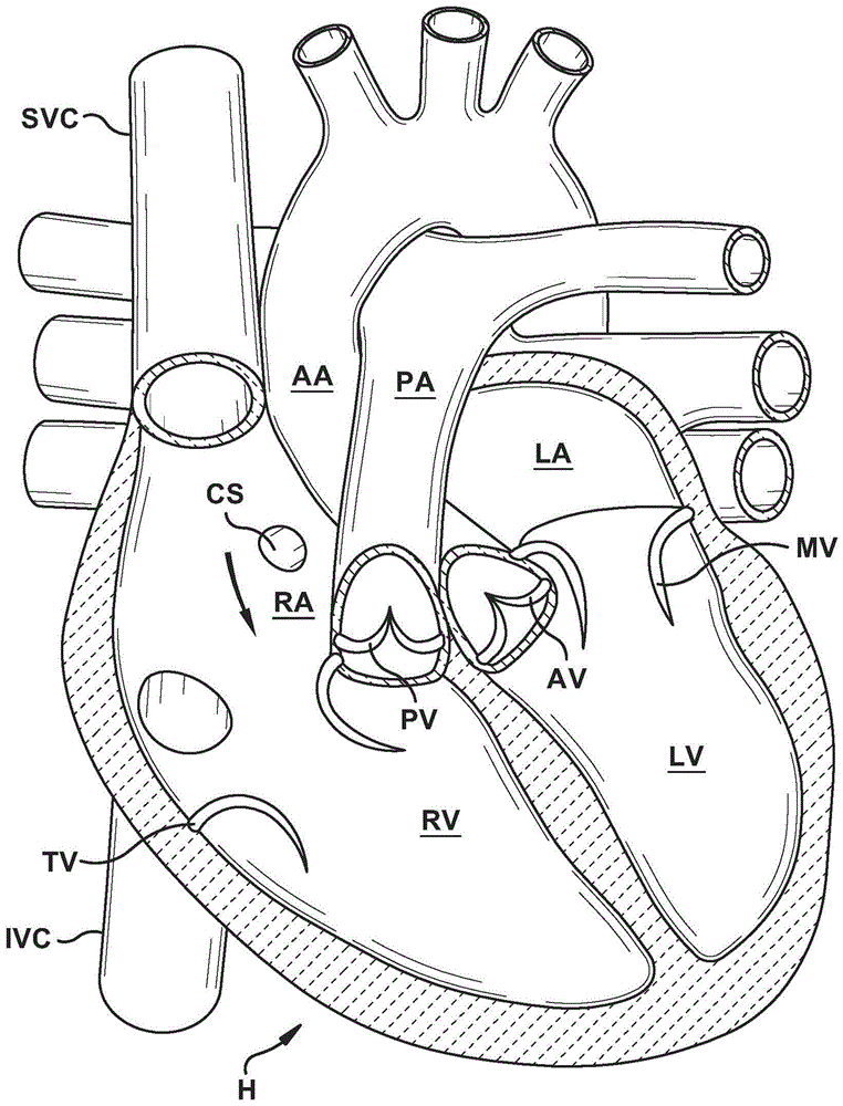 心脏瓣膜密封装置及其递送装置的制作方法