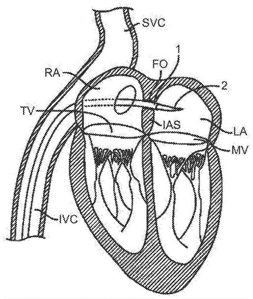 用于假体心脏瓣膜装置的液压系统及相关联的方法与流程