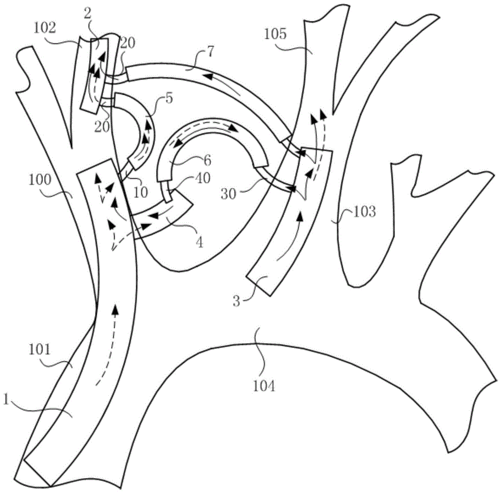 主动脉与双侧颈内动脉颅内转流的装置的制作方法