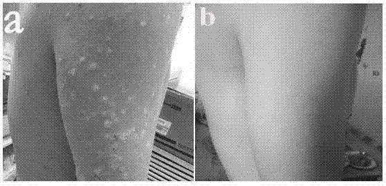 结核化疗药物在银屑病治疗中的应用的制作方法