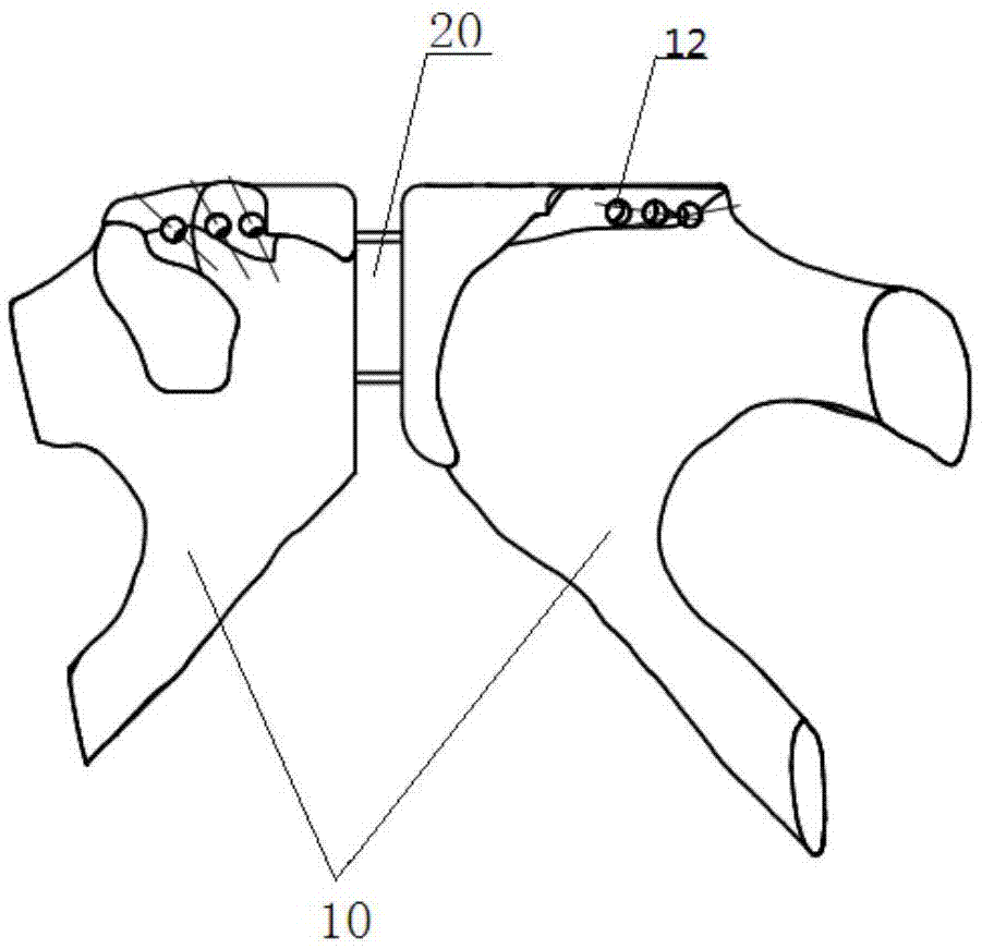 耻骨假体组件的制作方法