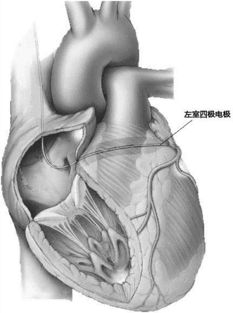 一种基于单电极实现CRT治疗的心脏起搏器及心脏起搏系统的制作方法