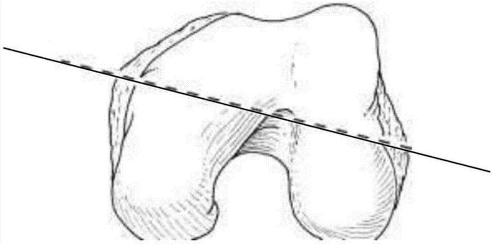 初次膝关节置换术前计划MRI/CT扫描及计算机影像处理方法与流程