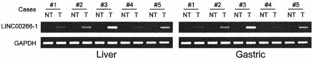 LINC00266-1 RNA作为实体瘤标志物的应用的制作方法