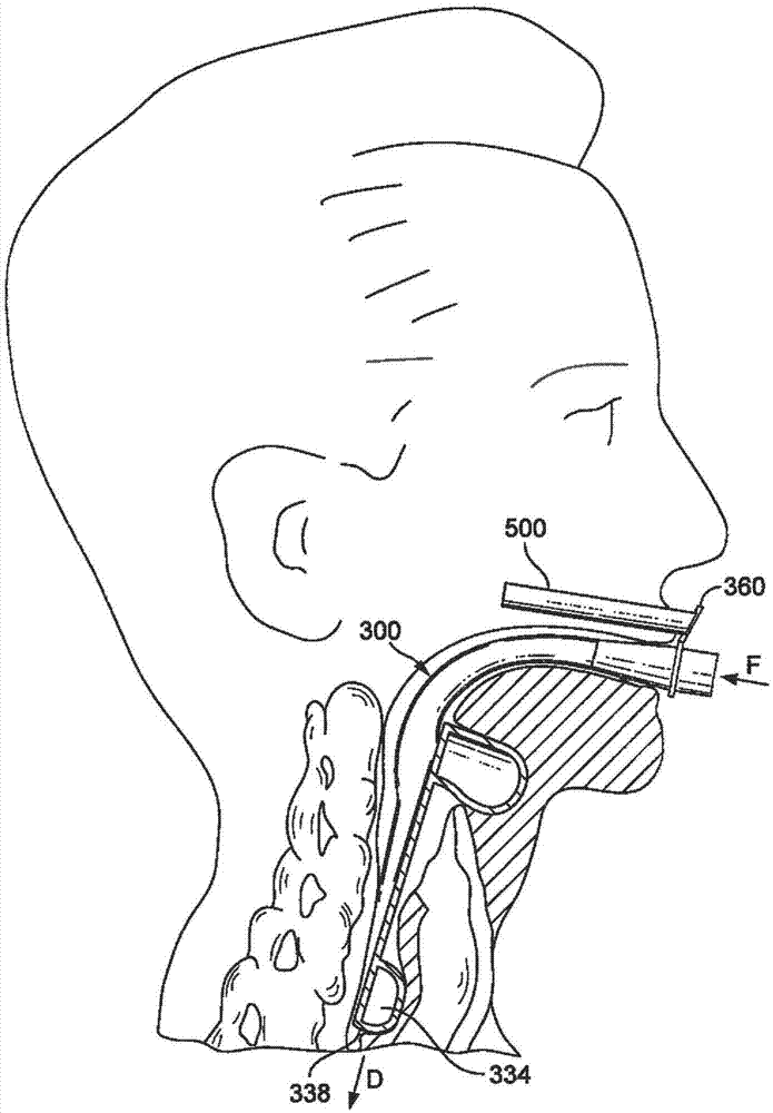 用于喉罩的固定装置的制作方法