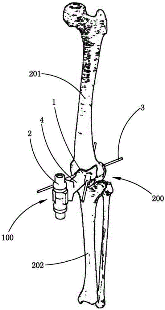 下肢机械轴校准装置的制作方法