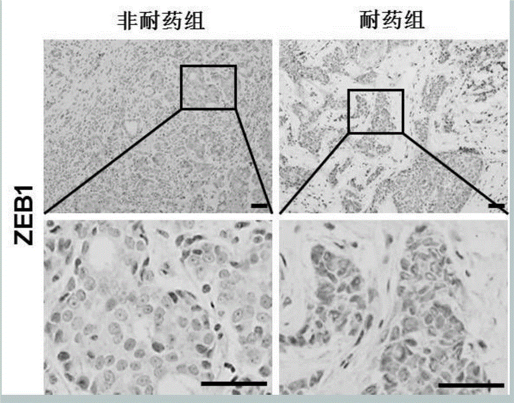 基于转录因子ZEB1在制备促进乳腺癌化疗敏感性的药物中的应用的制作方法