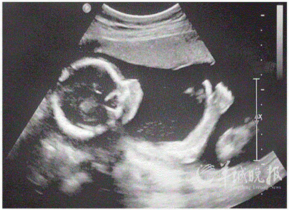 胎儿成像系统和方法与流程