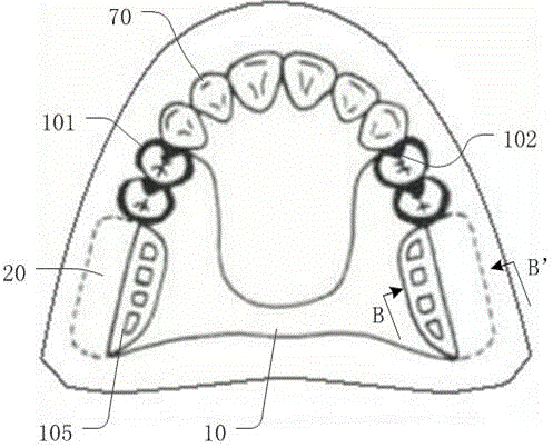 一种可摘局部义齿及其制作工艺的制作方法