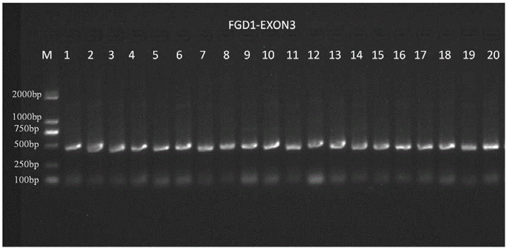 检测FGD1基因突变的引物和方法与流程