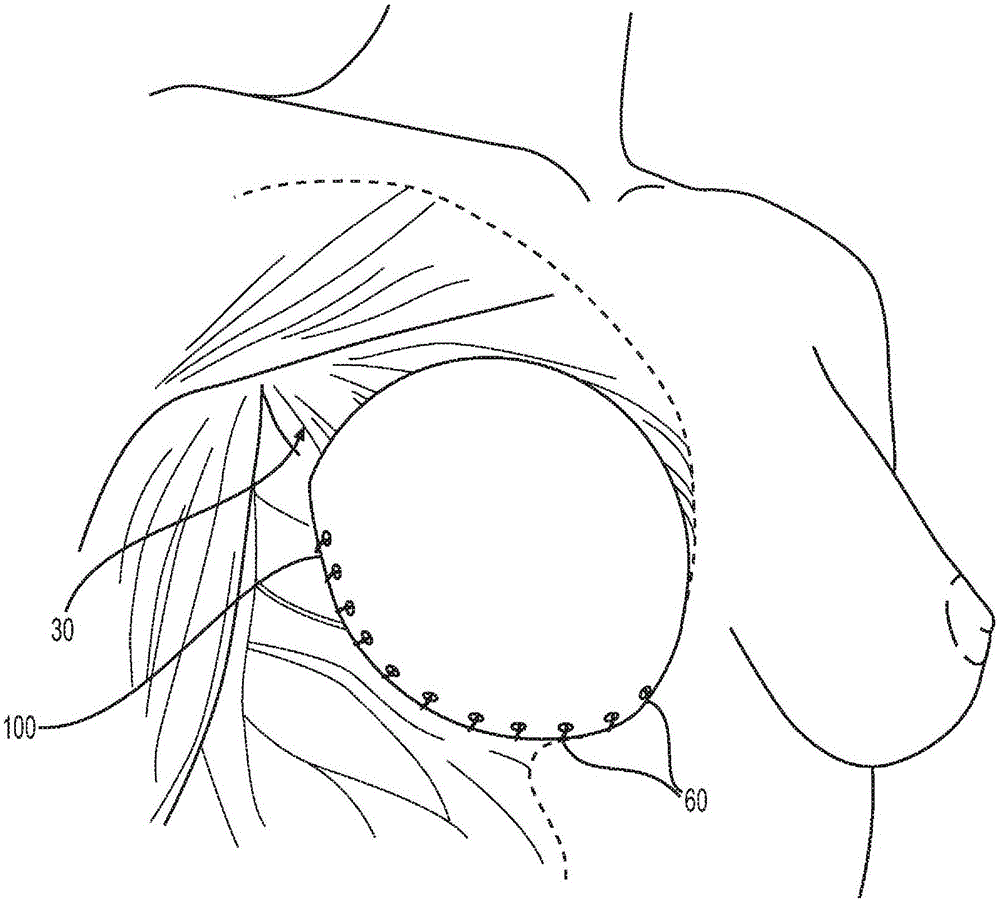 乳房治疗装置的制作方法