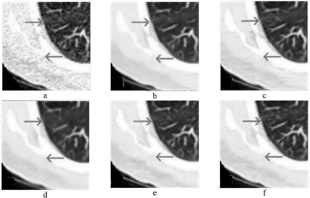 基于DNST域双变量收缩和双边非局部均值滤波的医学PET图像去噪方法与流程