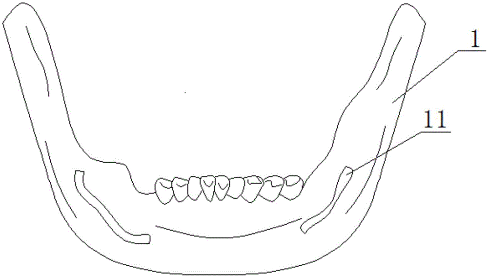 具有拓扑优化结构的骨面锚定式牙种植体设计方法及种植体与流程