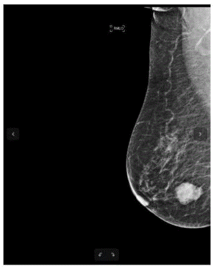 一种乳腺影像识别的方法及装置与流程