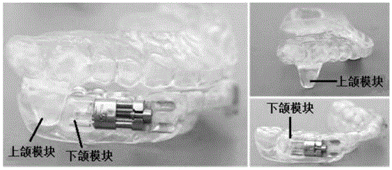 可调节式下颌前导器的制作方法