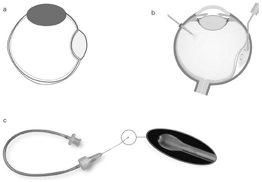 一种用于孔源性视网膜脱离的脉络膜上腔加压水凝胶球囊装置的制作方法