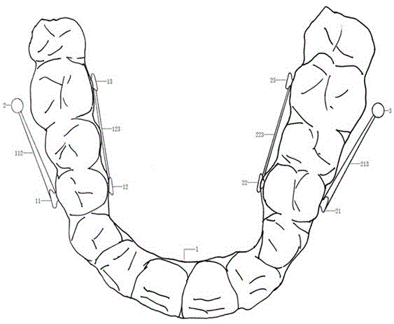 一种Ⅲ类错颌个性化定制隐形正畸矫治器的制作方法