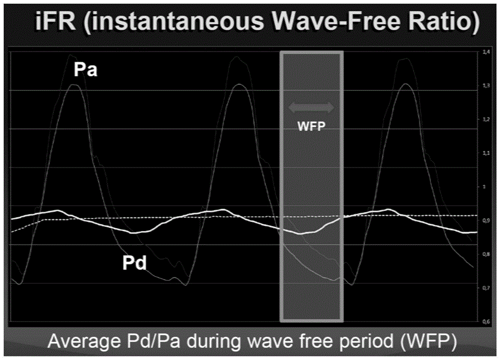 基于压力传感器和造影图像计算瞬时无波形比率的方法与流程