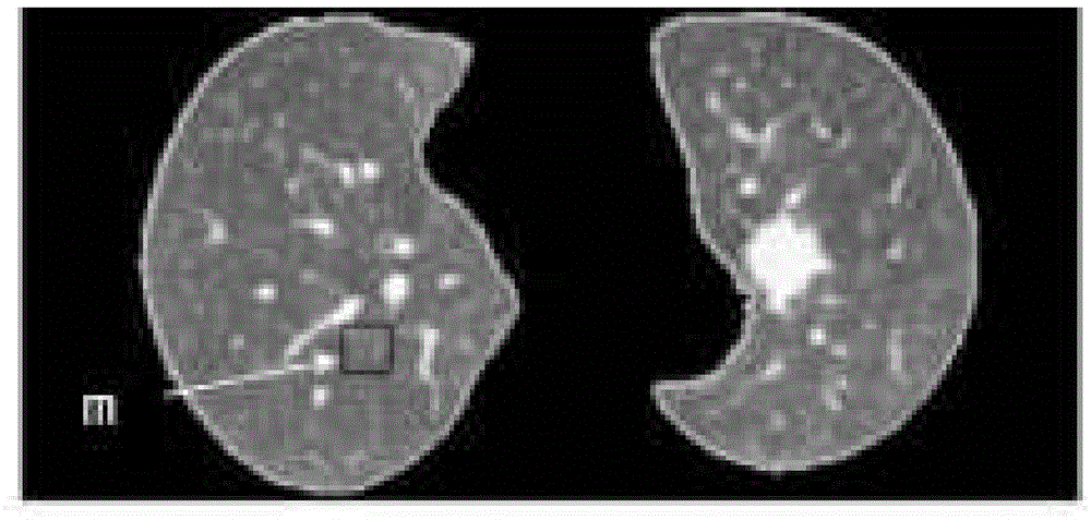 一种肺部病灶病变种子点的自动选择算法的制作方法