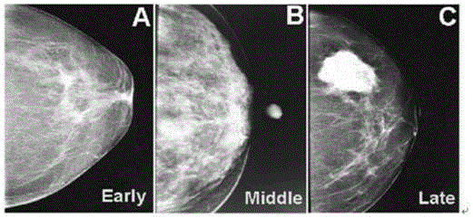 一种基于荧光传感阵列的快速筛查早中晚期乳腺癌技术的制作方法