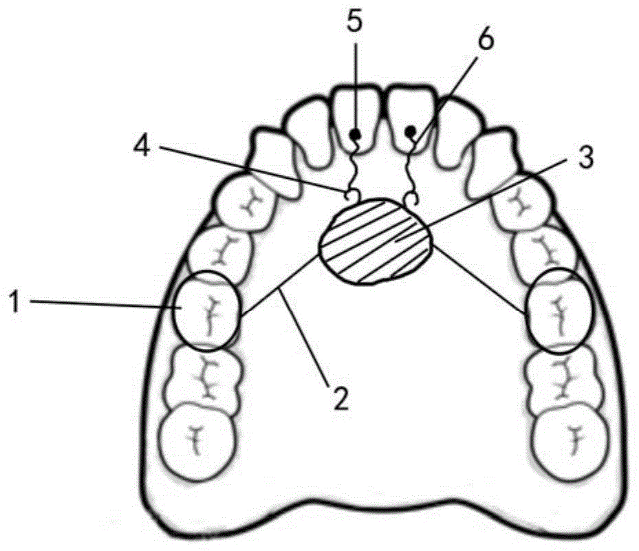 控制上颌前牙转矩的固定式装置的制作方法