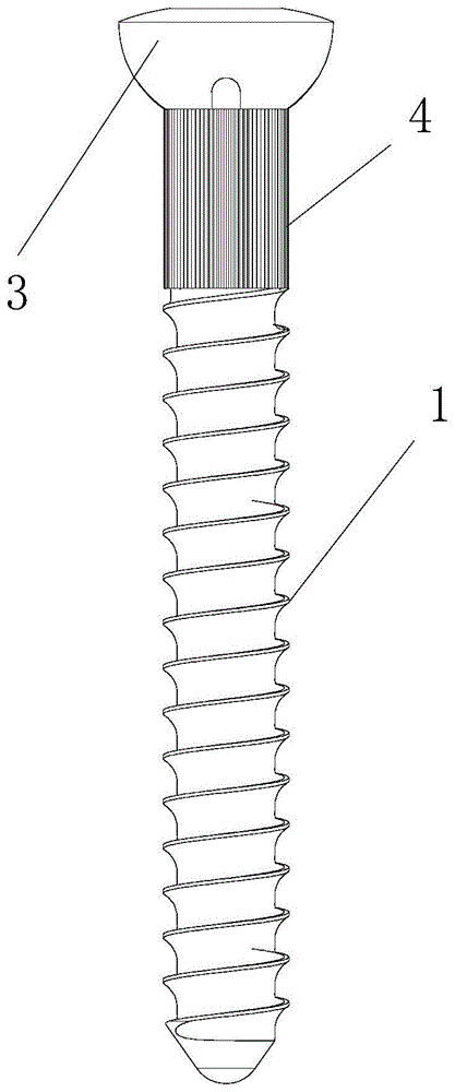 接骨自锁螺钉的制作方法