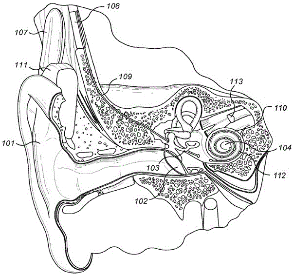 鼓膜102移动中耳103的骨骼,所述骨骼使得耳蜗104的卵圆窗和圆窗开口