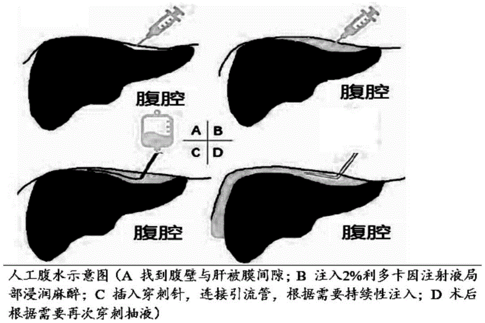 可视化胸腹水注射与抽吸装置及其辅助装置的制作方法