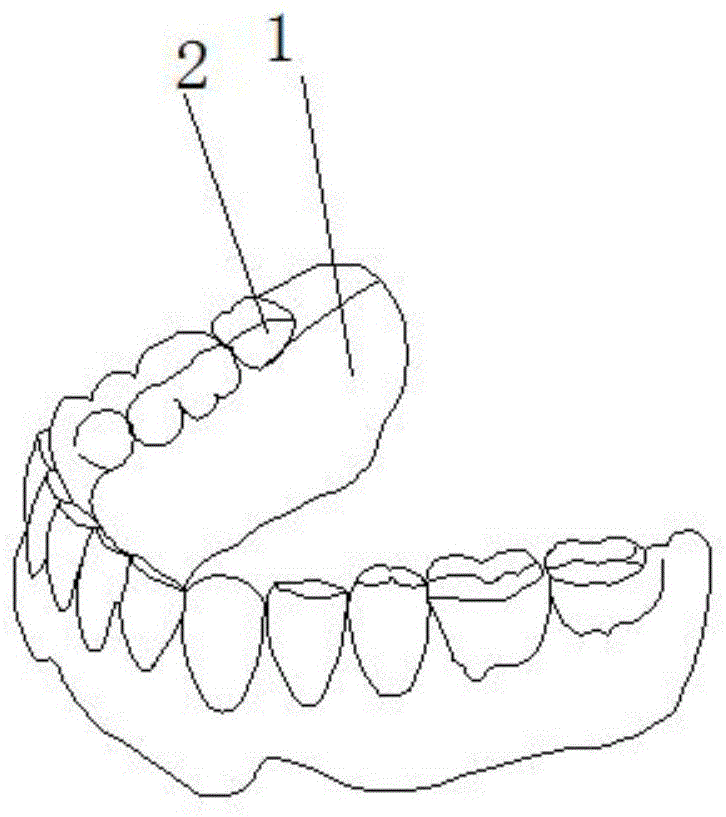 一种组装简便且有抑菌效果的定制式义齿的制作方法