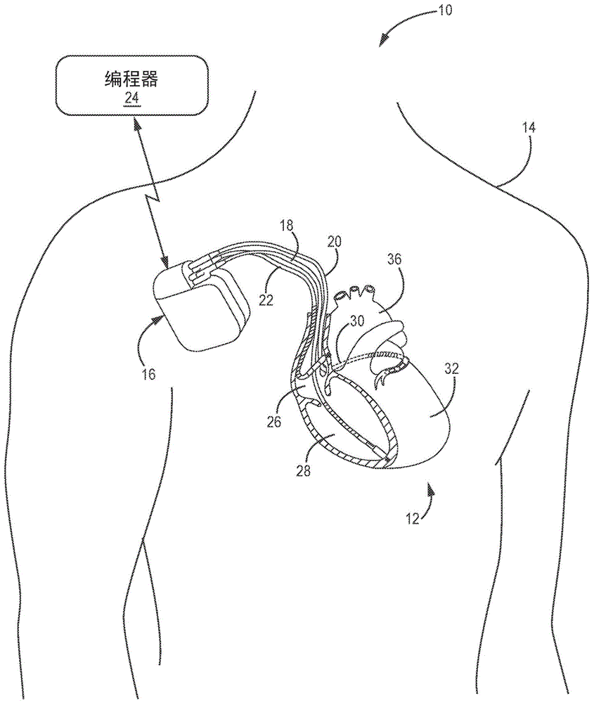 起搏器介导的心动过速检测和干预的制作方法