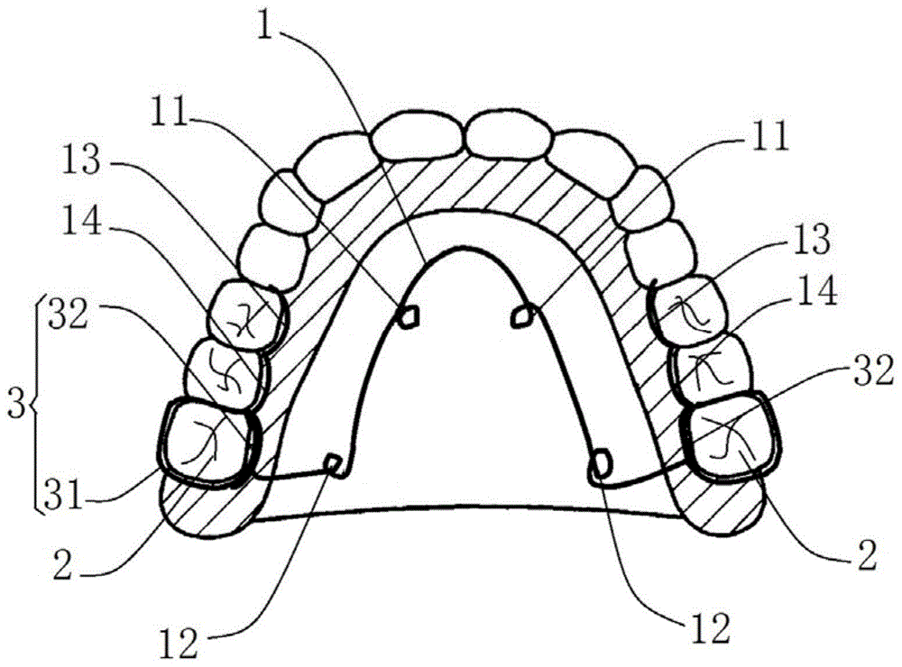 一种矫正牙弓形态的矫治器的制作方法