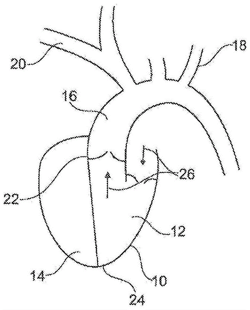 主动脉泵装置的制作方法