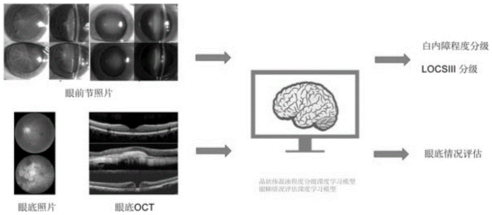 一种高度近视白内障手术预后智能预判系统的制作方法