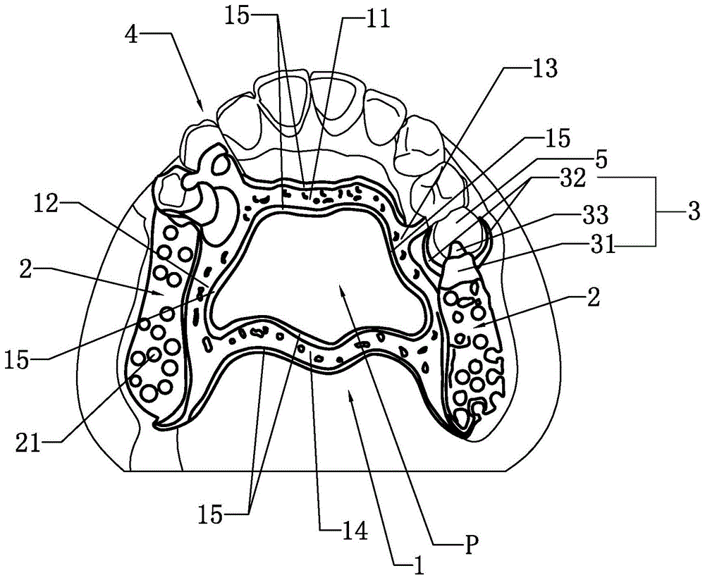 外两侧的卡环臂,以及卡环体上端向靠近基牙的方向延伸形成的卡托部,卡