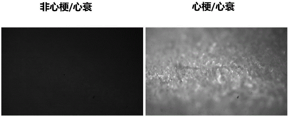 基于指甲自发荧光左右对称性和强度判断心肌梗死和心力衰竭及愈后程度的方法及其应用与流程