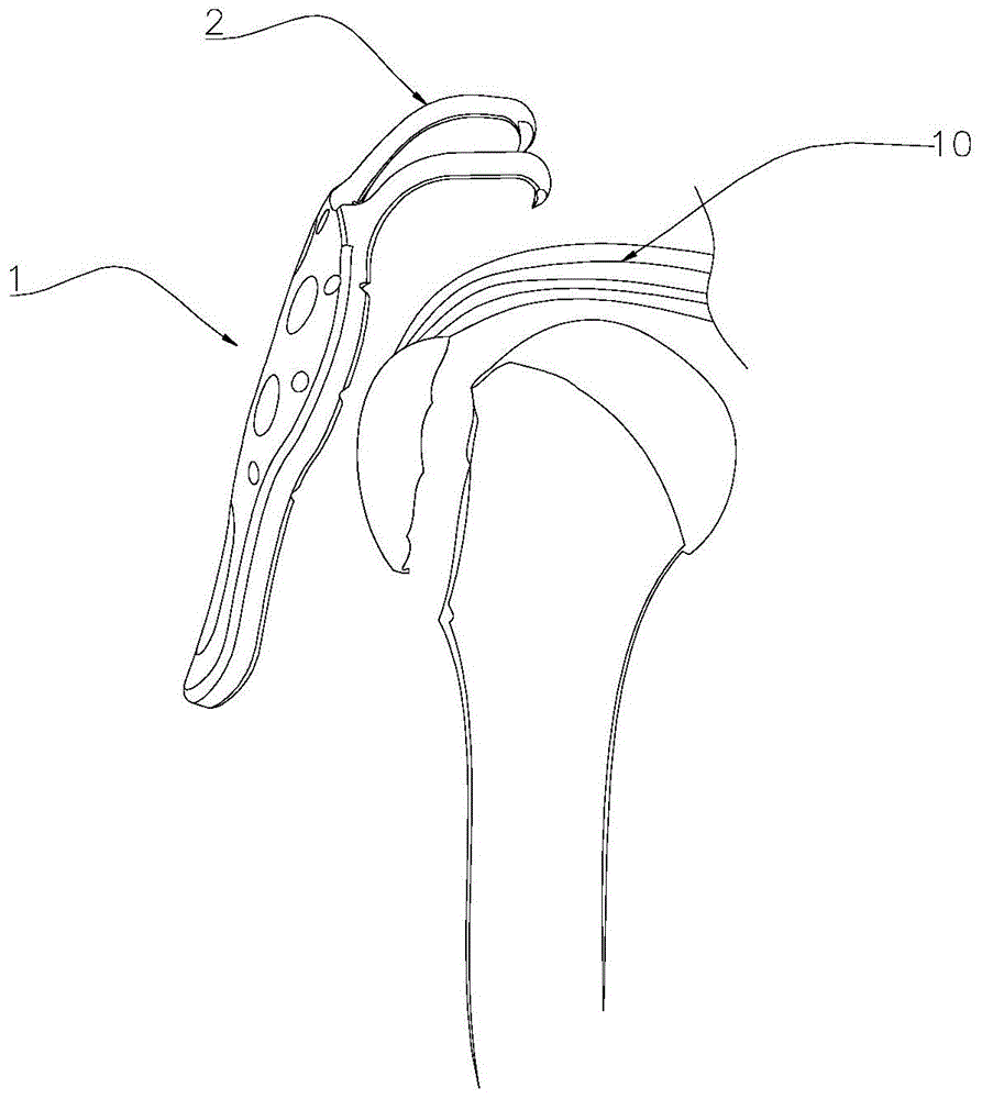 一种肱骨大结节撕脱骨折锁定板的制作方法