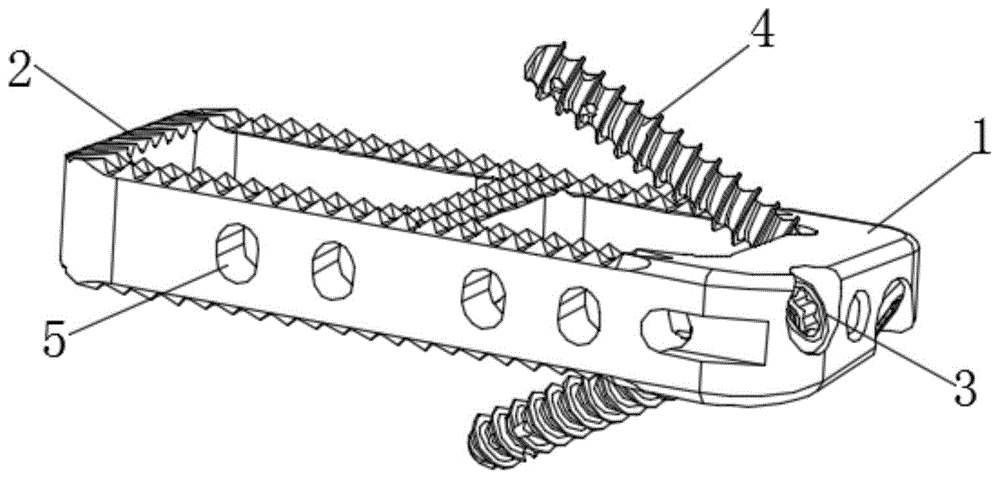 骨质疏松型锁定脊柱融合器的制作方法