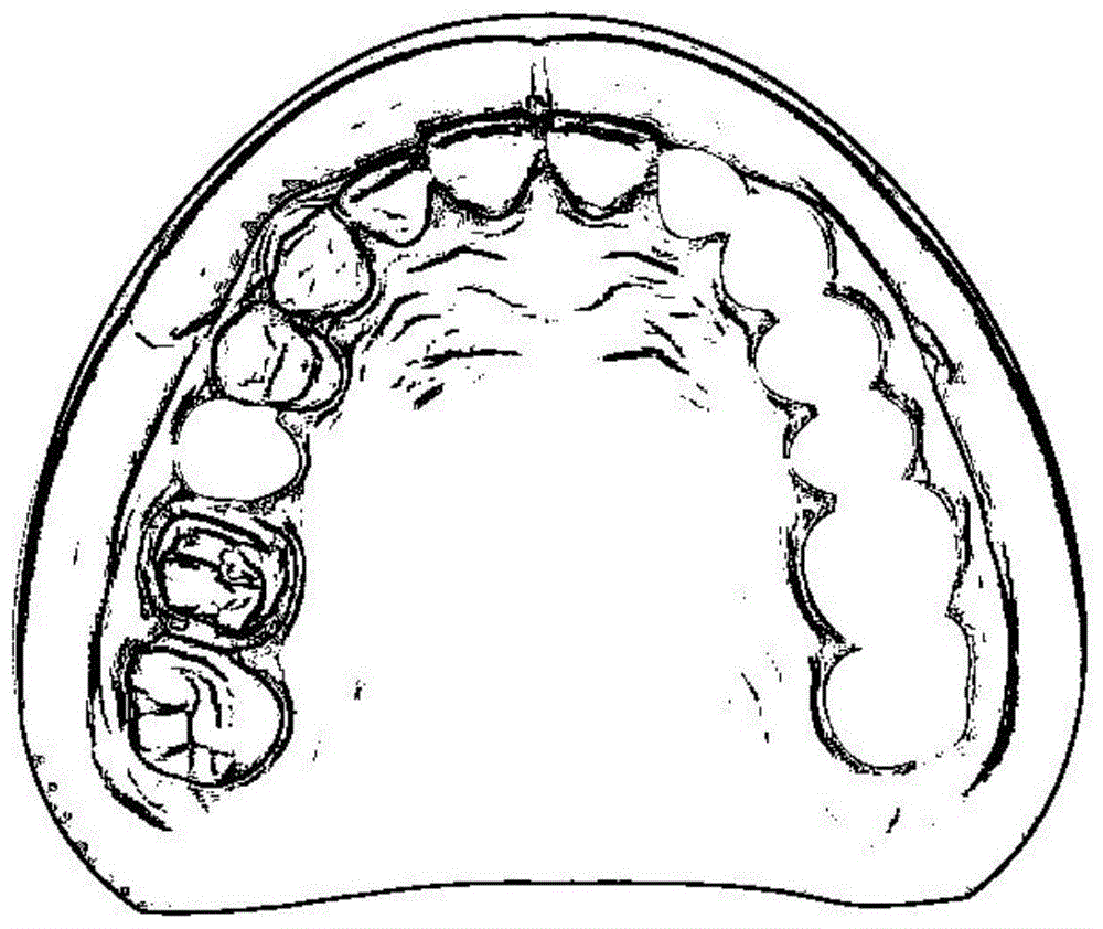 一种增减材复合加工成型的口腔赝复体支架制作方法与流程
