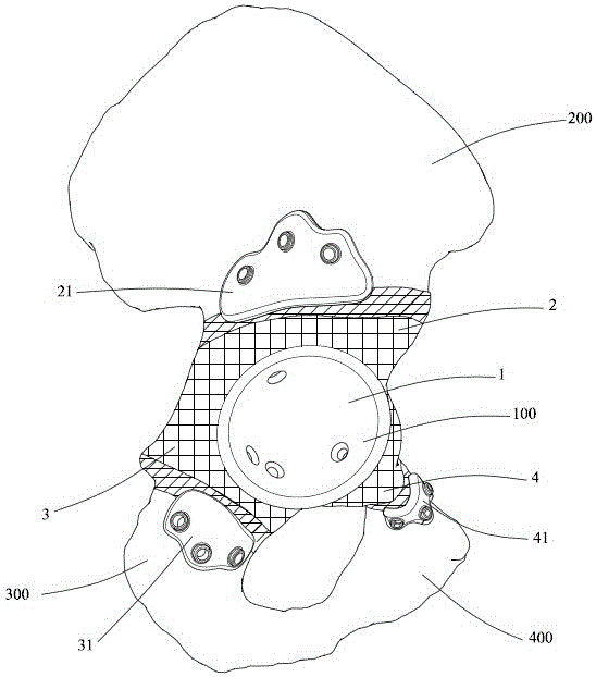 个性化双翼髋臼假体的制作方法